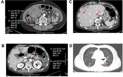 Case report: A case report and literature review of extrapancreatic solid pseudopapillary neoplasm